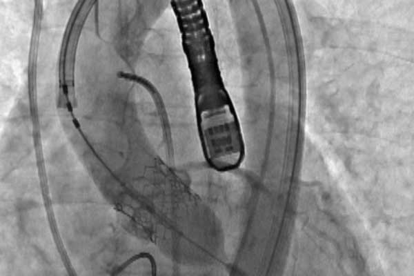 経カテーテル大動脈弁留置術イメージ